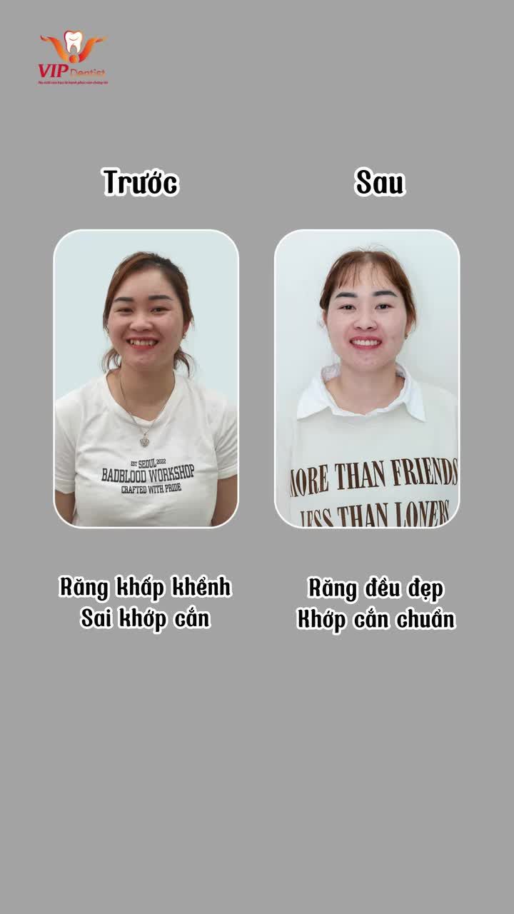Sau quá trình chỉnh nha với phác đồ độc quyền “Niềng Răng Không Nhổ Răng” tại nha khoa VIP Dentist, chị nữ khác hàng đã có sự thay đổi thế nào?