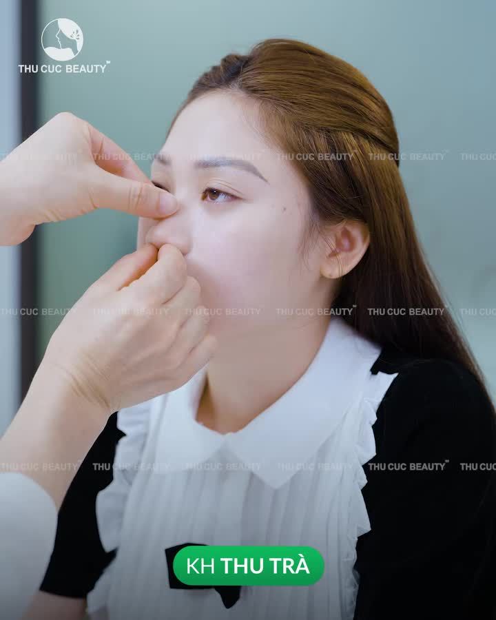 Nâng mũi xong gương mặt không còn góc chết: