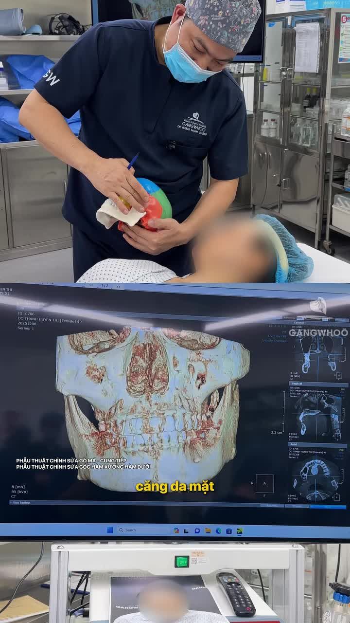 Chị khách Việt kiều chọn hạ gò má + gọt hàm và kết quả thay đổi ngoạn mục