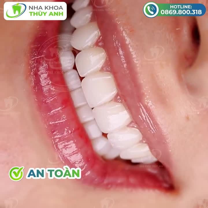 LÀM ĐẸP NỤ CƯỜI SIÊU NHANH GIÁ SIÊU TỐT TẠI NHA KHOA THÙY ANH