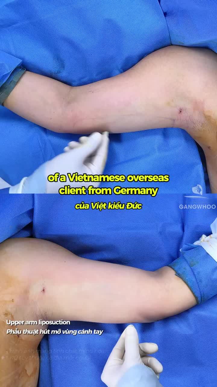 Kết quả phẫu thuật hút mỡ vùng cánh tay của Việt kiều Đức và chia sẻ hài lòng ở phòng hậu phẫu.