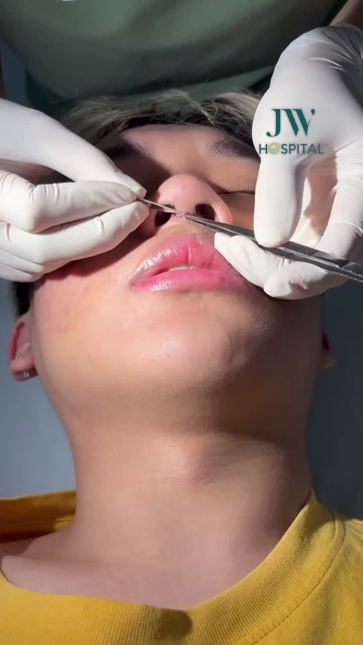 BẬT NGỬA TRƯỚC NHAN SẮC CỰC ĐIỂN TRAI CỦA NAM SINH GEN Z SAU NÂNG MŨI S LINE 3D TẠI JW