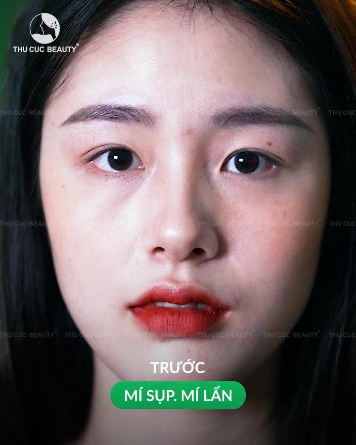 Mí sụp khiến đôi mắt buồn và thiếu sức sống?