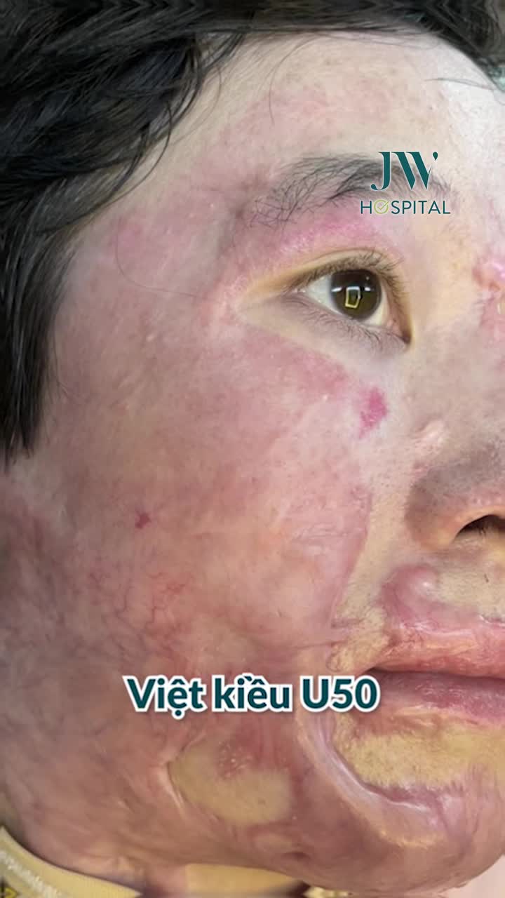 U50 VIỆT KIỀU ĐÀI LOAN HỒI HƯƠNG XOÁ 80% SẸO BỎNG CHỈ SAU 4 BUỔI ĐIỀU TRỊ TẠI JW