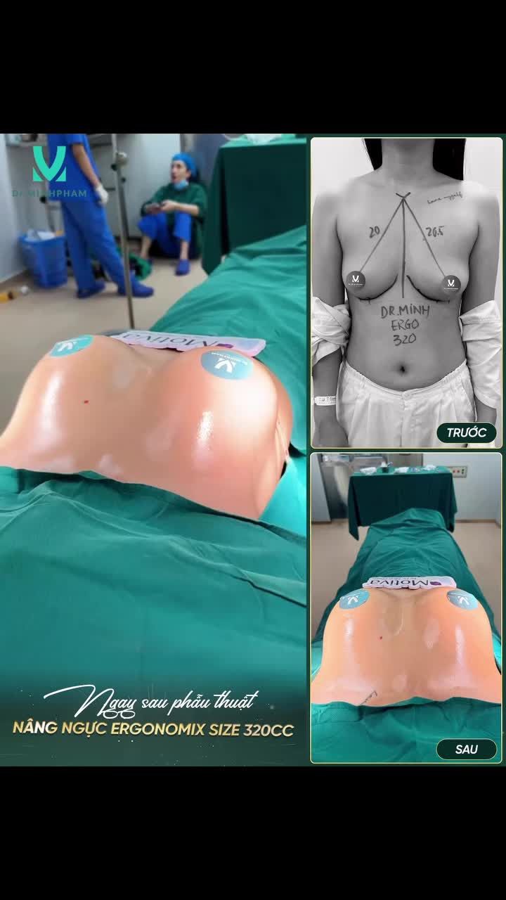 NÂNG NGỰC BÂY GIỜ ĐỂ KỊP ĐÓN TẾT