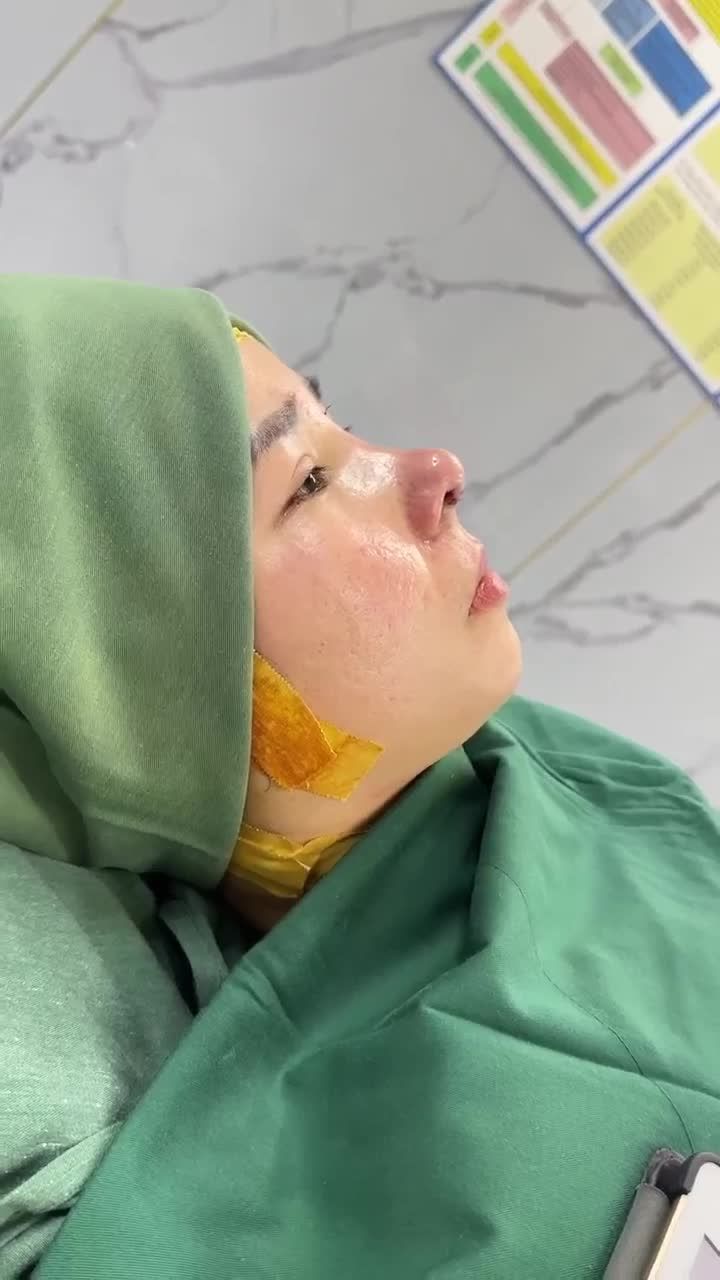 KẾT QUẢ SAU 60 PHÚT NÂNG MŨI CẤU TRÚC DR. HOẠT