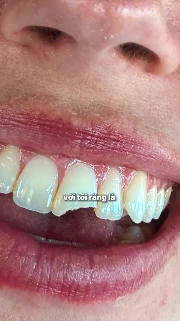 Răng mẻ, răng vỡ không còn là "nỗi lo" khi đến với Viet Smile. Chỉ 25 phút để lấy lại sự tự tin và diện mạo rạng rỡ nhất.