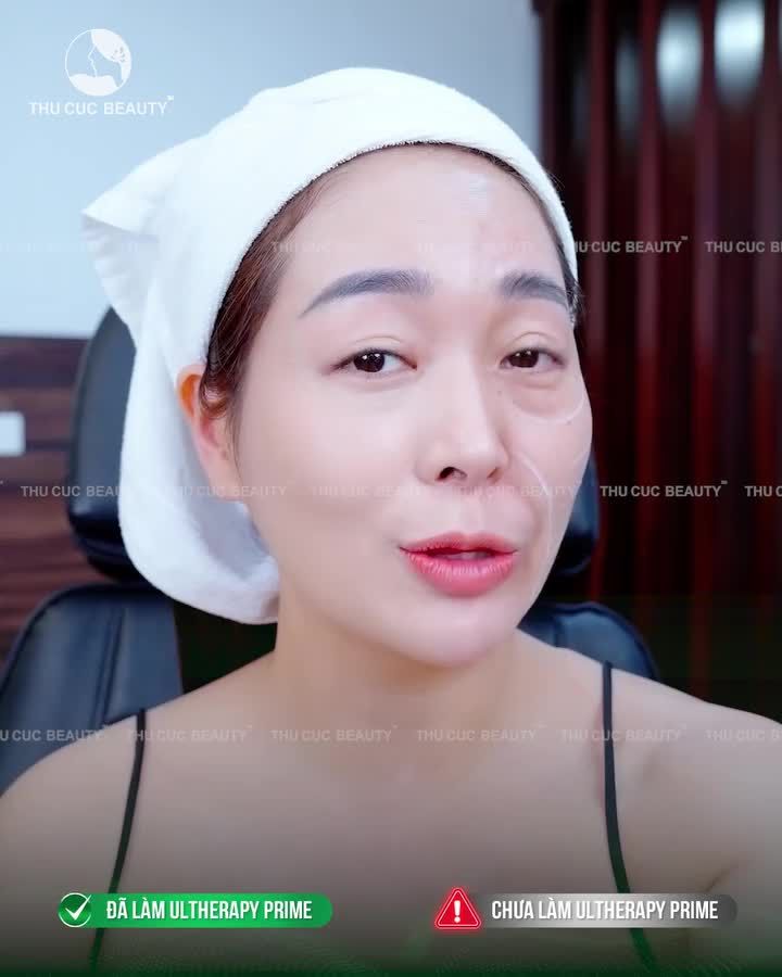 45P "Đảo ngược" lão hóa cùng siêu phẩm Ultherapy Prime