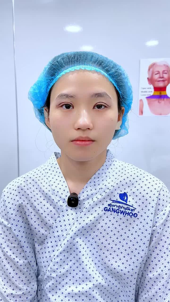 CẬN CẢNH KẾT QUẢ CẮT MÍ SAU 45 PHÚT – KHÔNG SƯNG, KHÔNG BẦM, ĐẸP NGAY TỨC THÌ