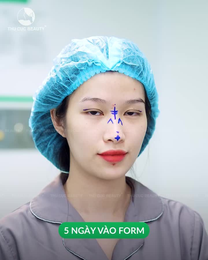 Mũi thấp tẹt được cải thiện chỉ sau 30P với Mũi TC