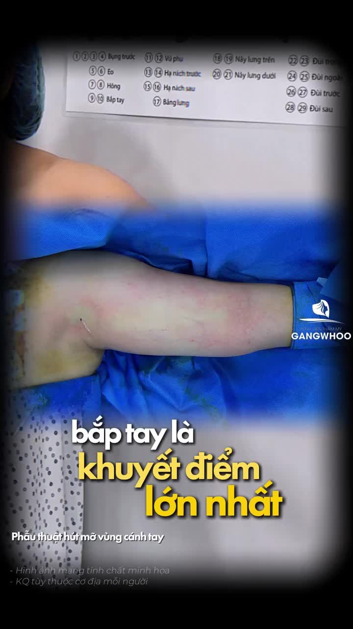 Nỗi tự ti ngày Tết của bao chị em và kết quả sau 30 phút phẫu thuật hút mỡ vùng cánh tay tại Gangwhoo