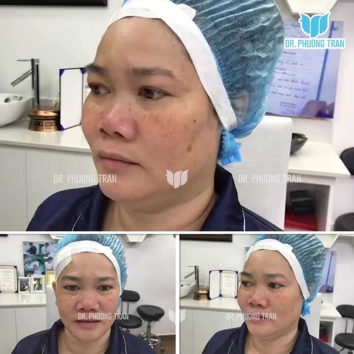 sống mũi gần như không rõ, da mỏng; đầu mũi to và ngắn thì nên nâng mũi như thế nào?