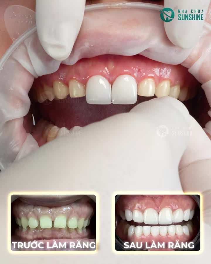 RĂNG THƯA XỈN MÀU KHỚP CẮN SÂU Liệu có khắc phục được khuyết điểm chỉ sau 48h?