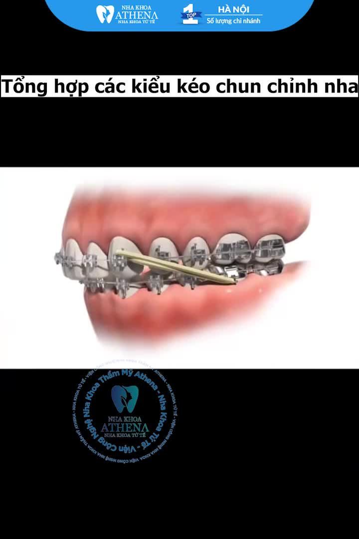 Một sợi thun nhỏ xíu, mỏng manh nhưng lại giữ vai trò "then chốt" để đưa nụ cười về đích hoàn hảo. Đó chính là DÂY THUN - THUN LIÊN HÀM!