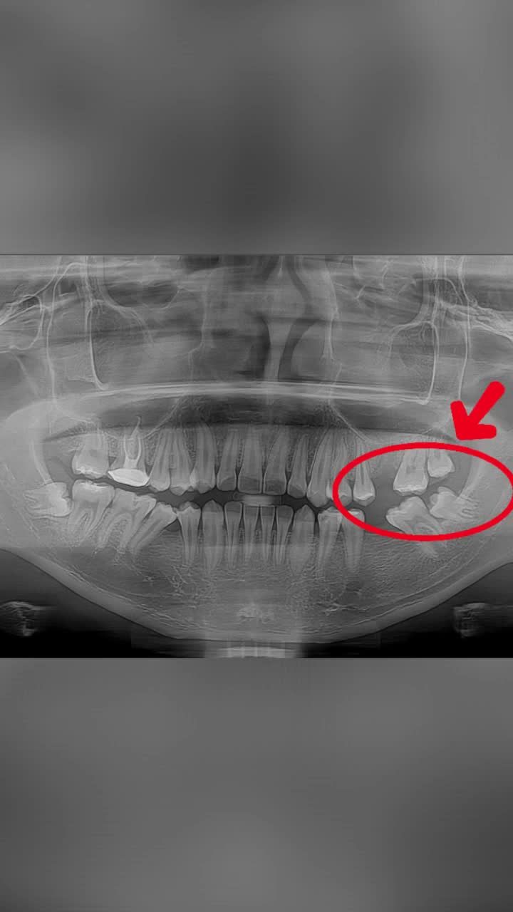 Mất 2 răng 6 niềng kéo răng 7 răng 8