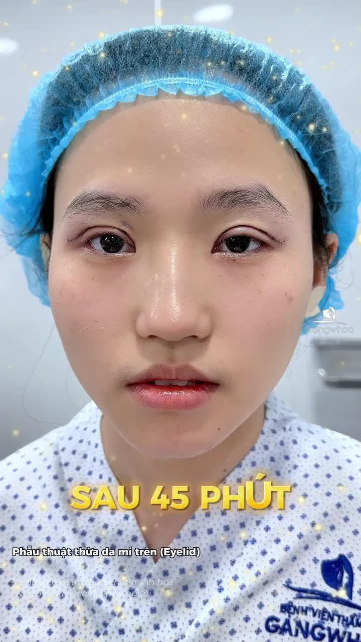 Du học sinh Nhật nghỉ Tết tranh thủ nâng cấp đôi mắt hai mí tại Gangwhoo.