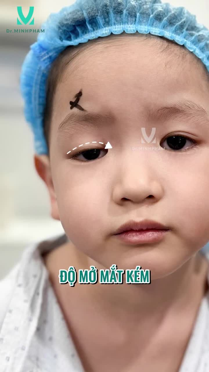 SỤP MI BẨM SINH Ở TRẺ – KHÔNG CHỈ CÒN LÀ VẤN ĐỀ THẨM MỸ