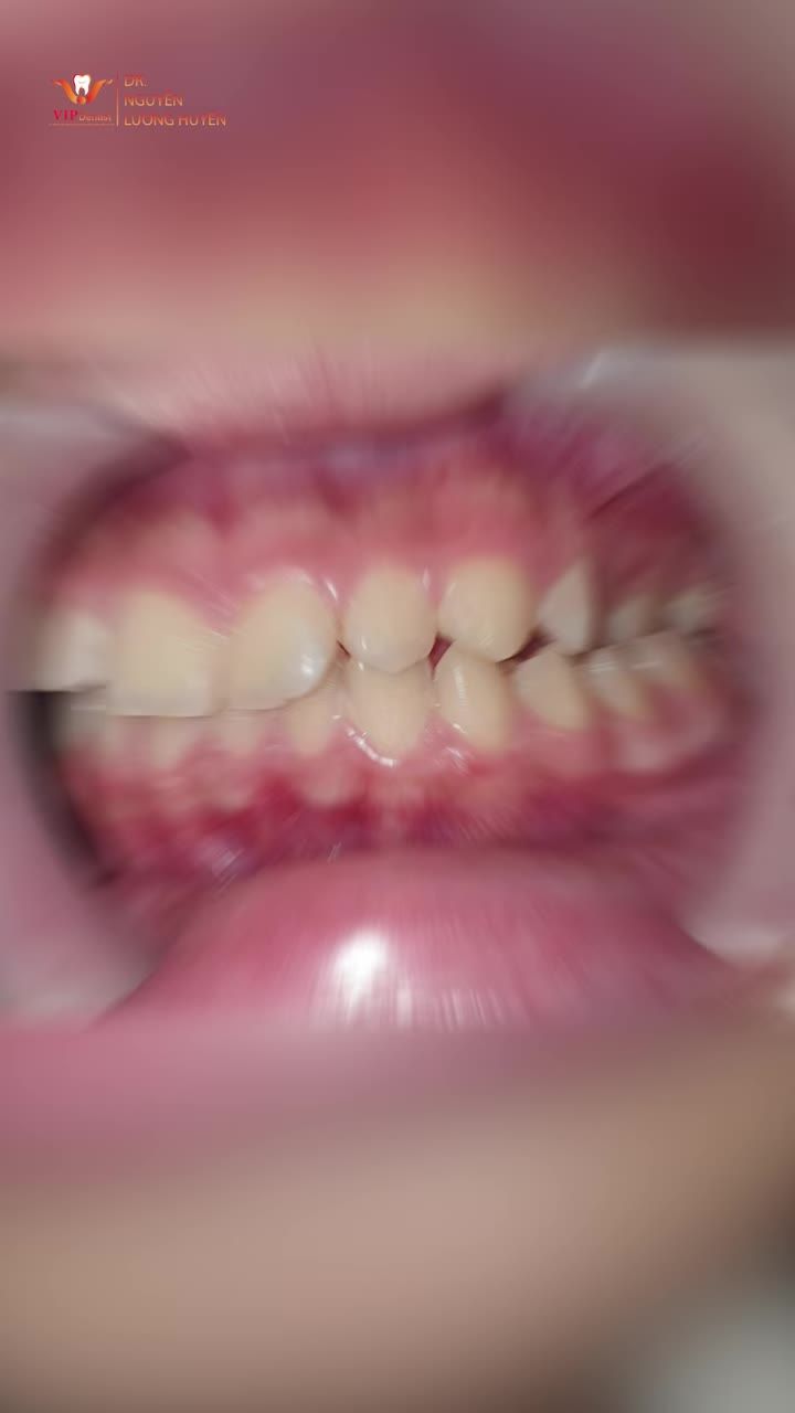 Bạn nữ khách hàng sau quá trình NIỀNG RĂNG KHÔNG NHỔ RĂNG tại VIP Dentist đã có sự thay đổi thế nào?