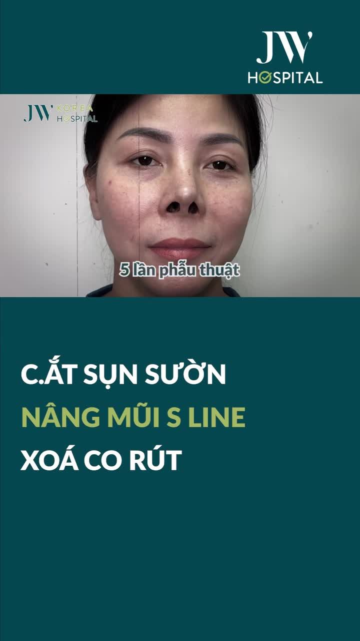 BÁC SĨ TÚ DUNG C.ẮT SỤN SƯỜN TÁI SINH MŨI CO RÚT THÀNH S LINE CAO SANG CHO VIỆT KIỀU ĐÀI LOAN