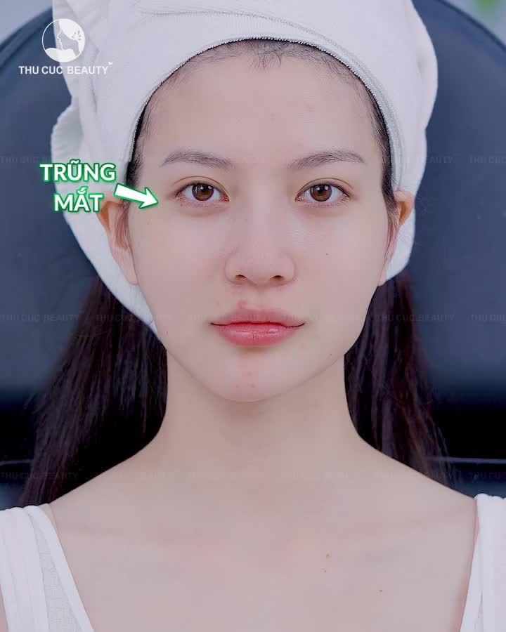 Má hóp - cằm lệch - thái dương trũng khiến gương mặt già & kém sắc hơn thật sự!