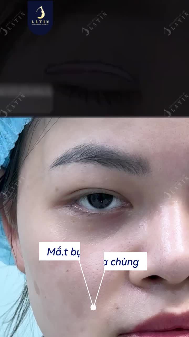 GIẢI QUYẾT MẮT BỤP HAI MÍ KHÔNG ĐỀU