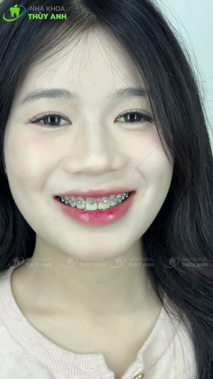 NIỀNG RĂNG ĐẸP LÊN THẤY RÕ BONUS CƠ HỘI NHẬN NGAY TÀI TRỢ 5 TRIỆU