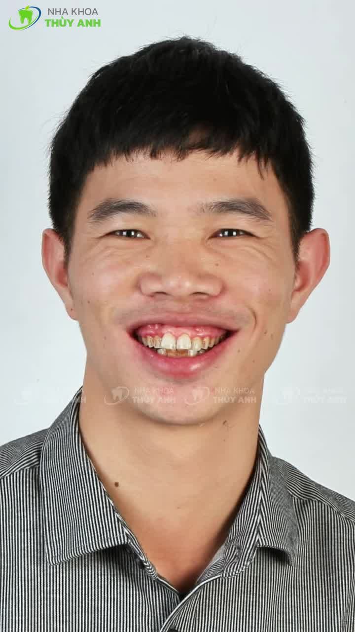 Từ một ca niềng khó anh Quyết thay đổi thế này, bạn thì sao?