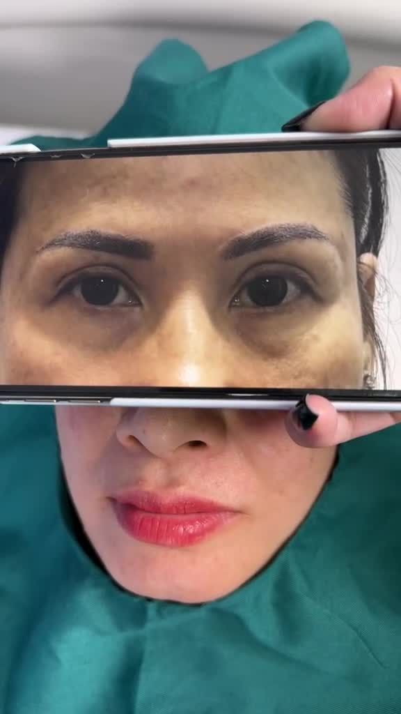 U50 Việt kiều Mỹ hóa MỸ NHÂN nhờ thực hiện TREO CHÂN MÀY và PHUN XĂM CHÂN MÀY tại JW