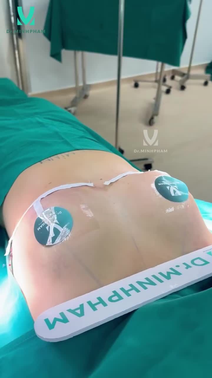 TREO SA TRỄ PHÌ ĐẠI LẤY LẠI VÒNG 1 GỌN GÀNG, SĂN CHẮC