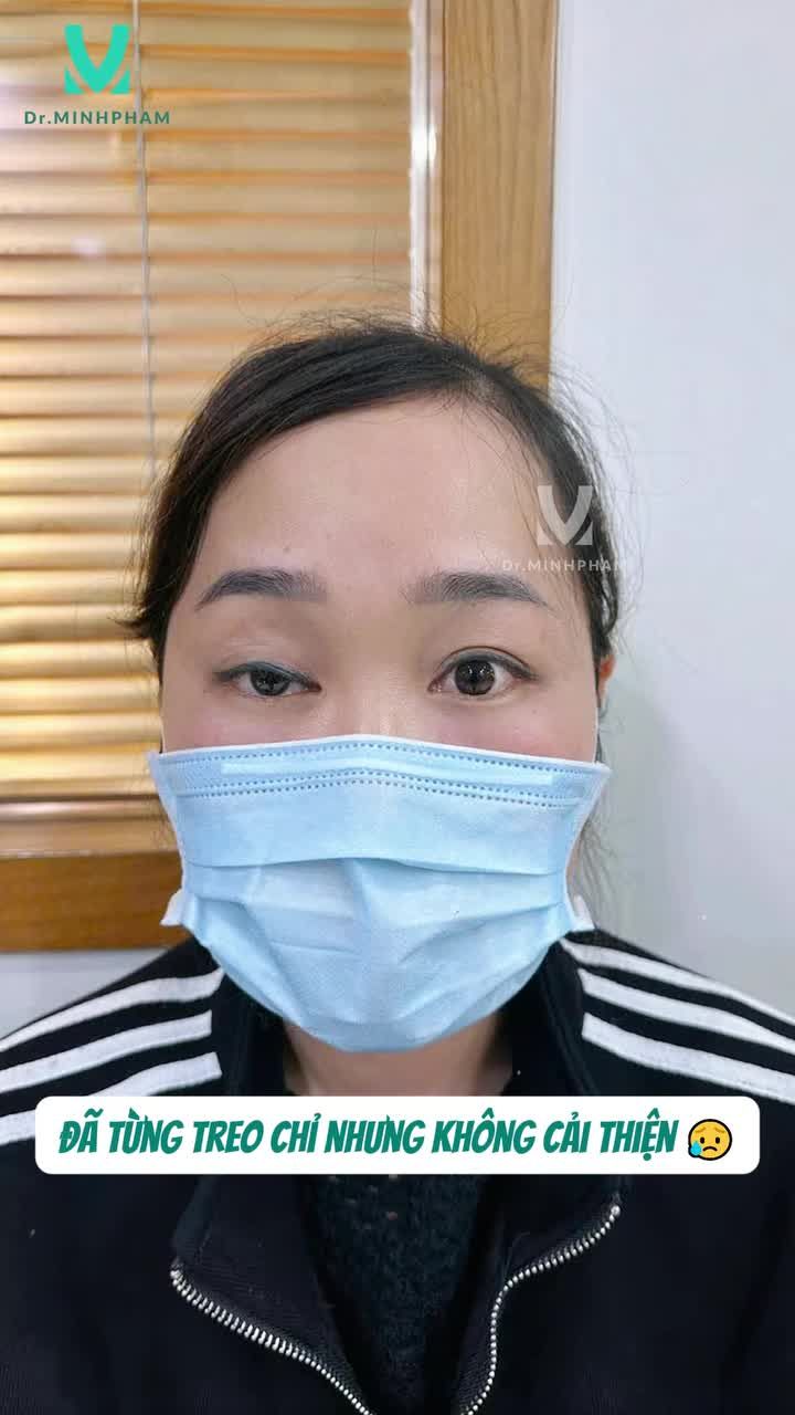 ĐÚNG PHƯƠNG PHÁP - ĐÔI MẮT CẢI THIỆN RÕ RỆT CHỈ SAU 1 THÁNG