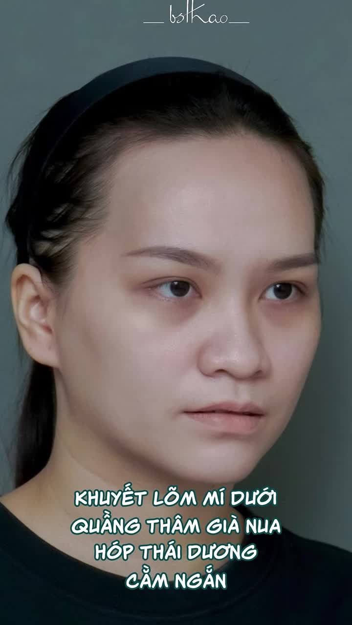 LÀM ĐẦY KHUYẾT LÕM, CẢI THIỆN TỶ LỆ, THAY ĐỔI ĐƯỜNG NÉT KHUÔN MẶT NHỜ CẤY MỠ!