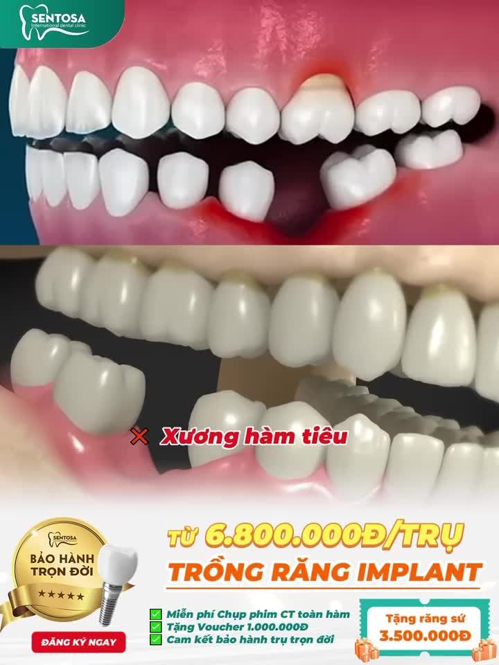 MẤT RĂNG ĐỪNG ĐỢI ĐẾN KHI KHÓ ĂN NHAI