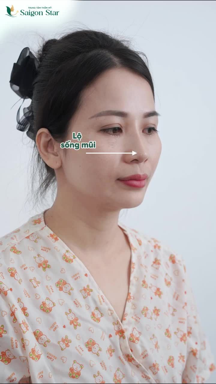 NÂNG MŨI SỤN SƯỜN - 10 NGÀY XÓA TAN MŨI HỎNG
