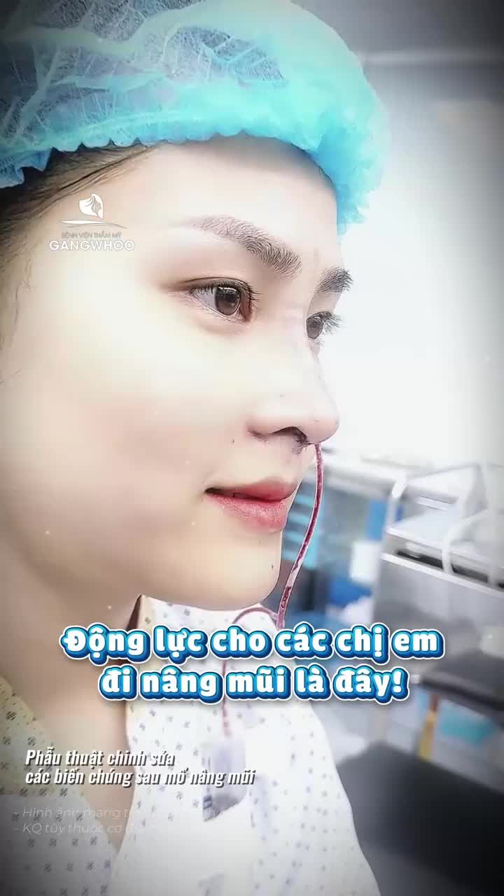 Hạnh phúc là khi sở hữu dáng mũi đẹp, an toàn, bền lâu sau phẫu thuật chỉnh sửa các biến chứng sau mổ nâng mũi