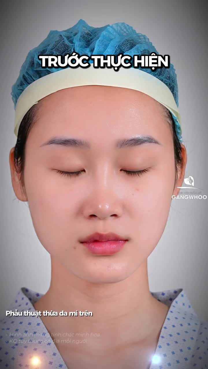 Bác sĩ đo vẽ trước khi cắt mí. Một bước nhỏ nhưng quyết định sự hài hòa và tự nhiên của cả gương mặt