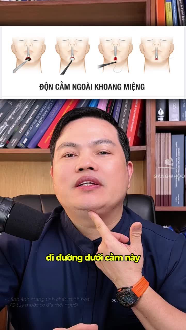 Ưu điểm độn cằm nội soi tại BVTM Gangwhoo