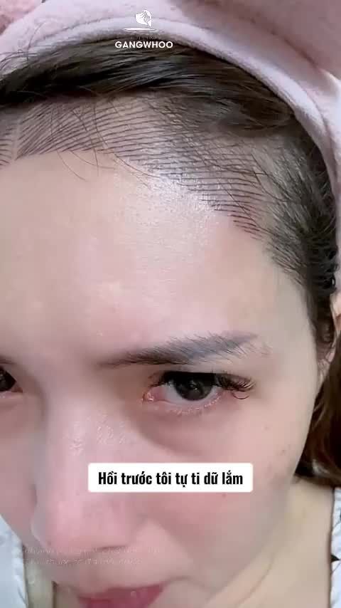 Hành trình thu ngắn trán sân bay xóa luôn đường xăm lỗi với hạ đường chân tóc nội soi vi phẫu tại Bệnh viện thẩm mỹ Gangwhoo