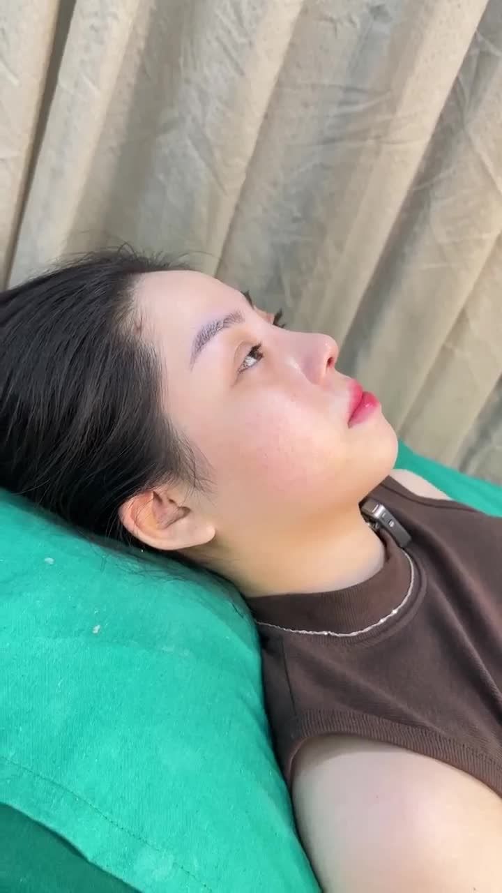 MŨI CAO TỰ NHIÊN SAU 10 NGÀY - ĐẸP KỊP ĐÓN TẾT