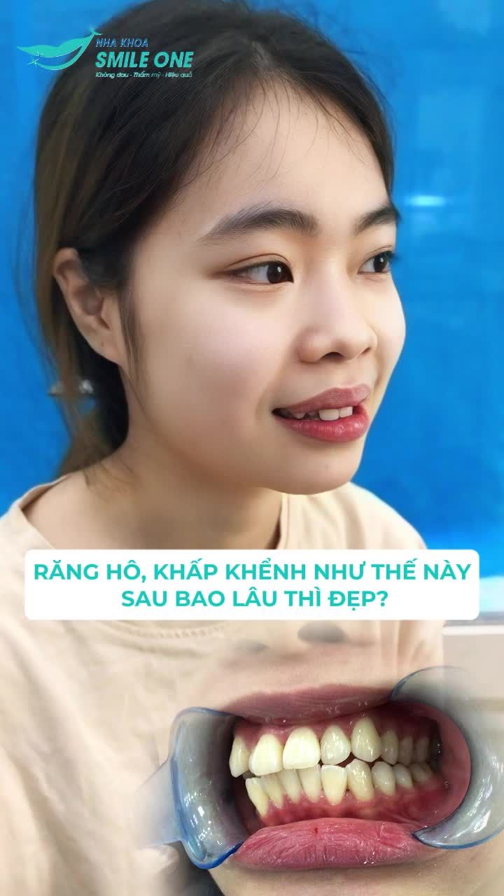 "Biến hình" sau Niềng răng khấp khểnh cùng cô nàng Thùy Trang