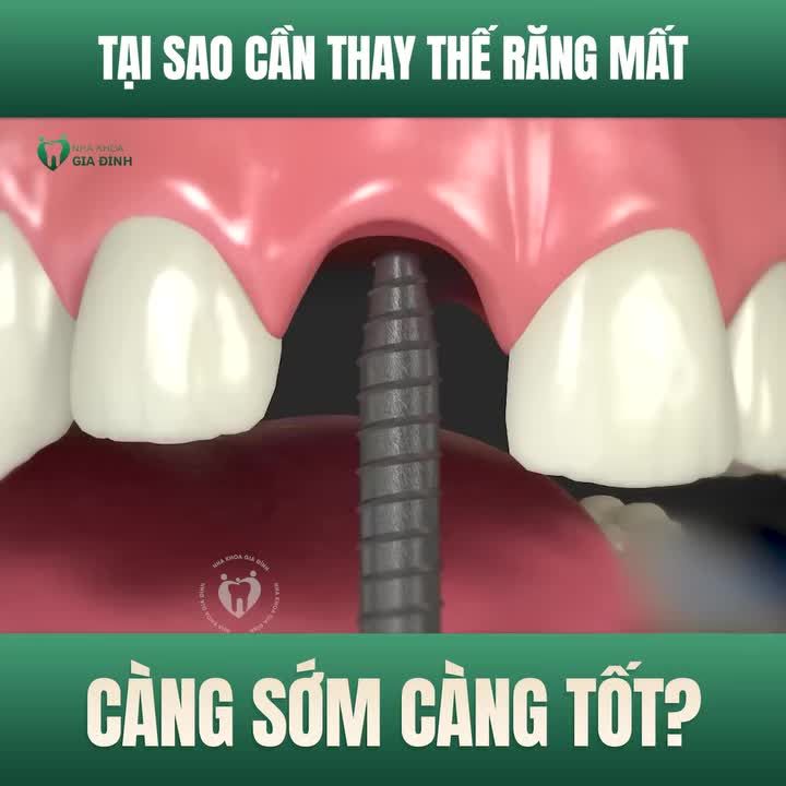 TẠI SAO CẦN THAY THẾ RĂNG MẤT CÀNG SỚM CÀNG TỐT?