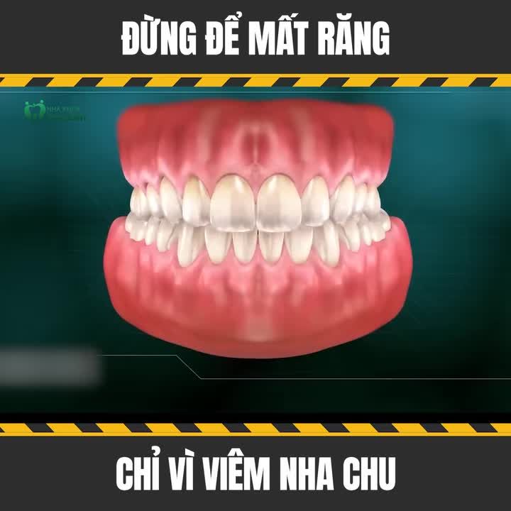 VIÊM NHA CHU – ĐỪNG CHỦ QUAN VÌ CÓ THỂ MẤT RĂNG RẤT SỚM!