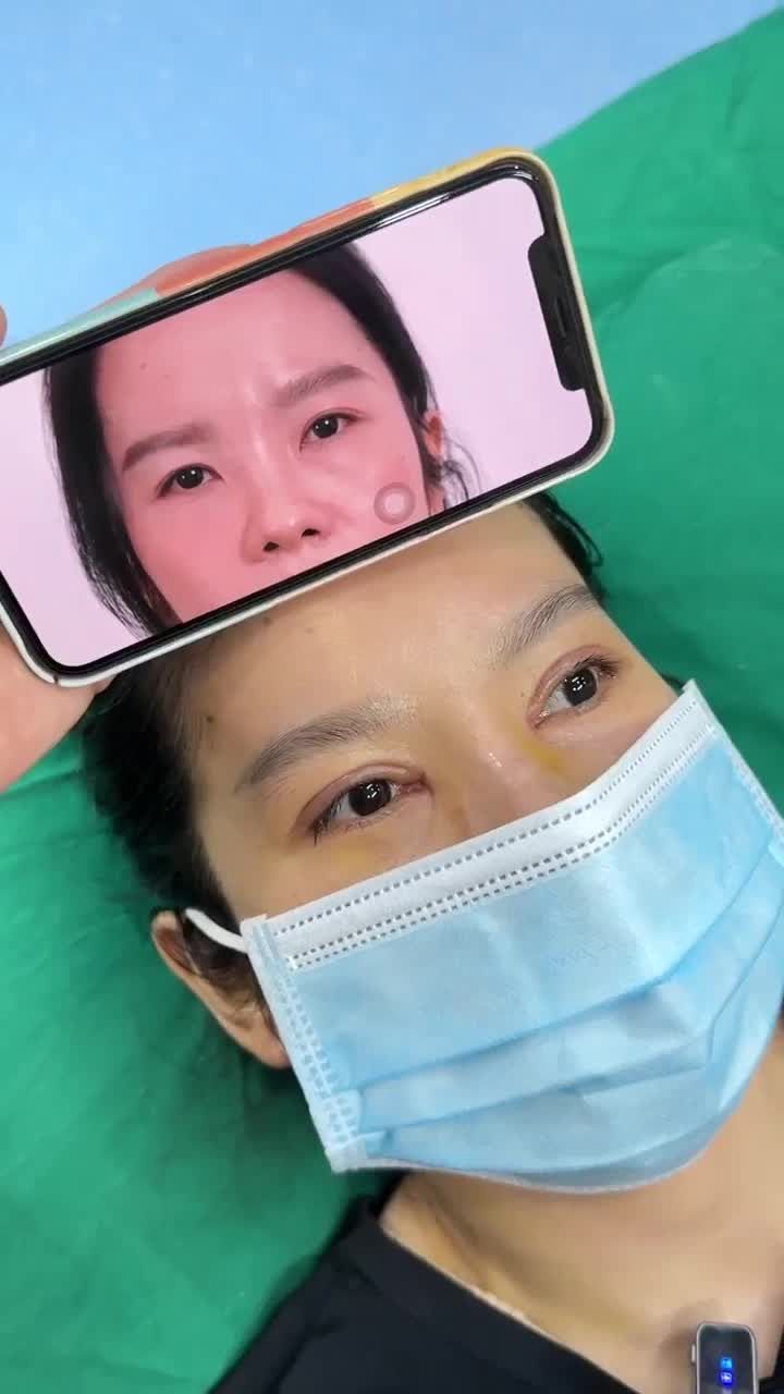 CẮT MÍ MINI DEEP - 10 NGÀY MẮT 2 MÍ TỰ NHIÊN ĐẸP KỊP ĐÓN TẾT