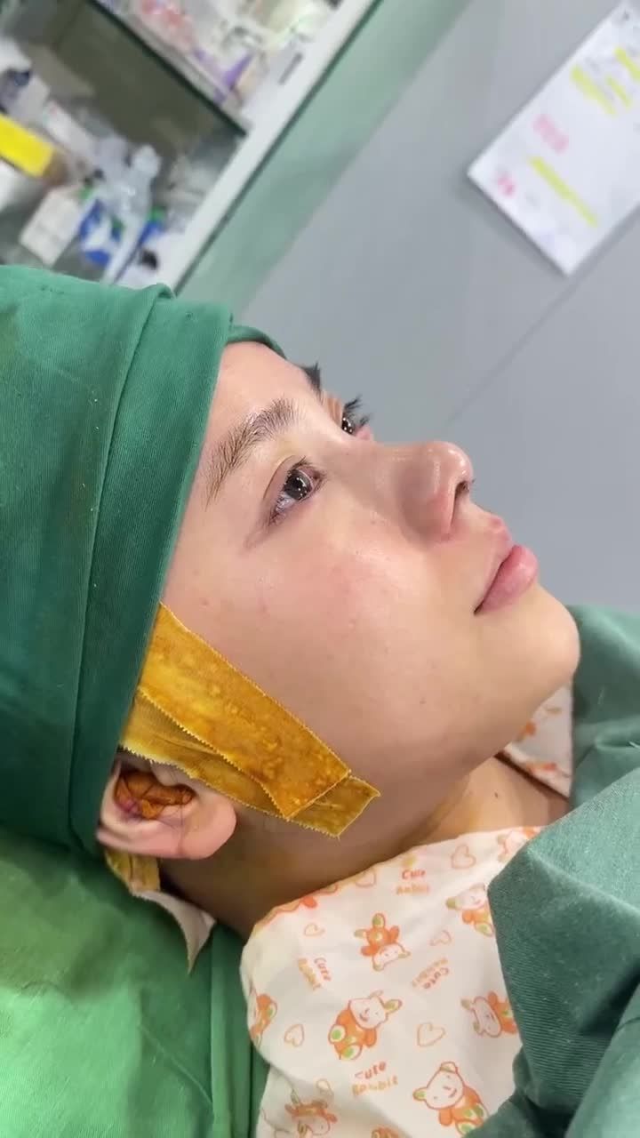 KẾT QUẢ SAU 60 PHÚT NÂNG MŨI SỤN SURGIFORM