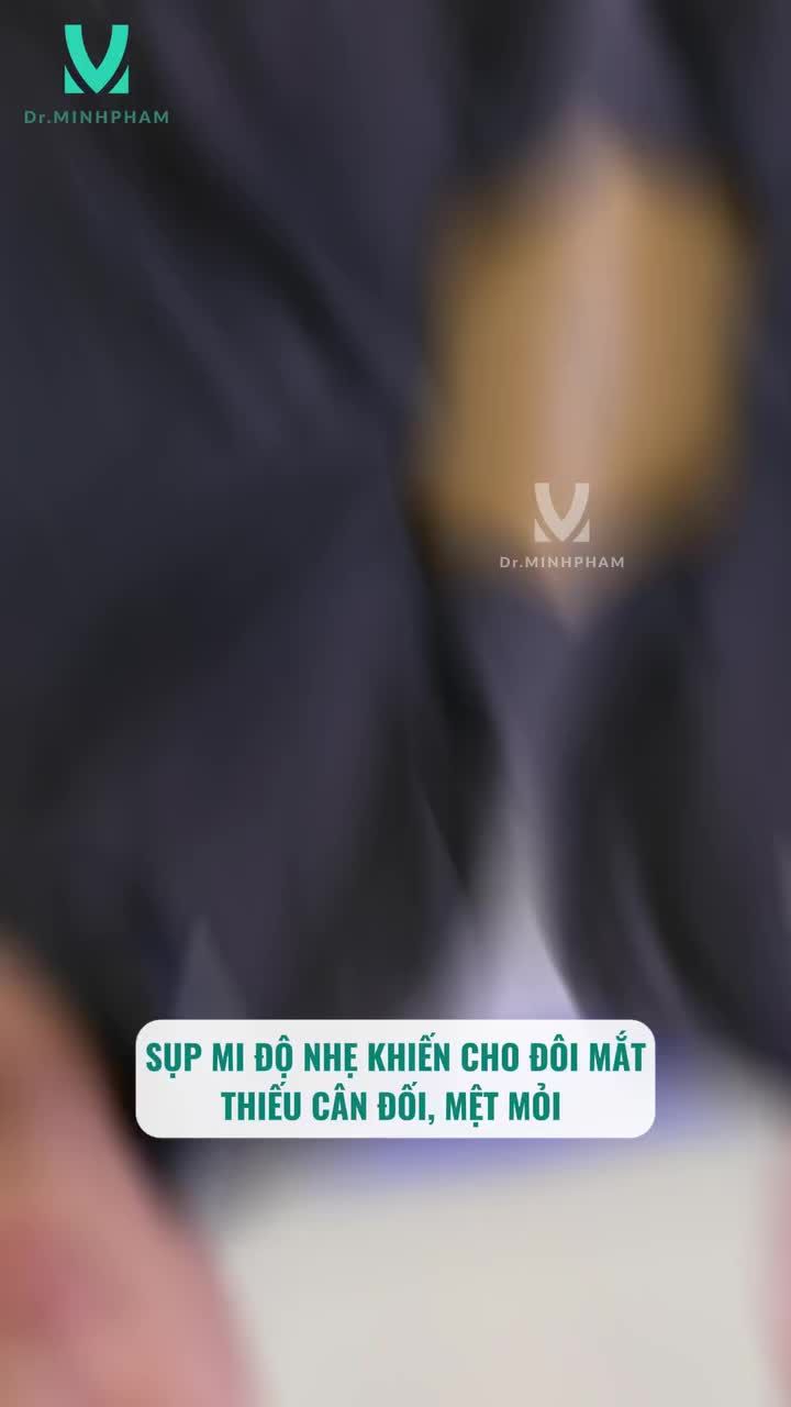 25 năm sụp mi bẩm sinh KH đã lấy lại sự tự tin chỉ sau 7 ngày phẫu thuật