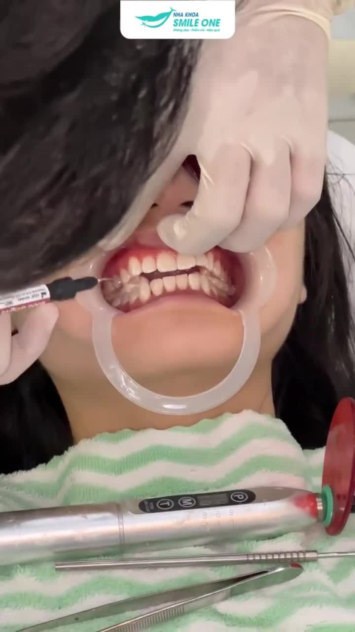 Tẩy trắng răng "đón Tết" bật tông x3 lần - Bạn đã thử chưa?