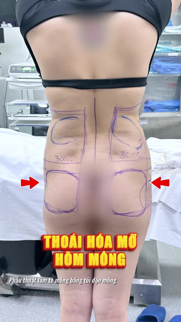 Nâng V3 "cấy vàng"  đẹp kịp tết, tự tin khoe dáng