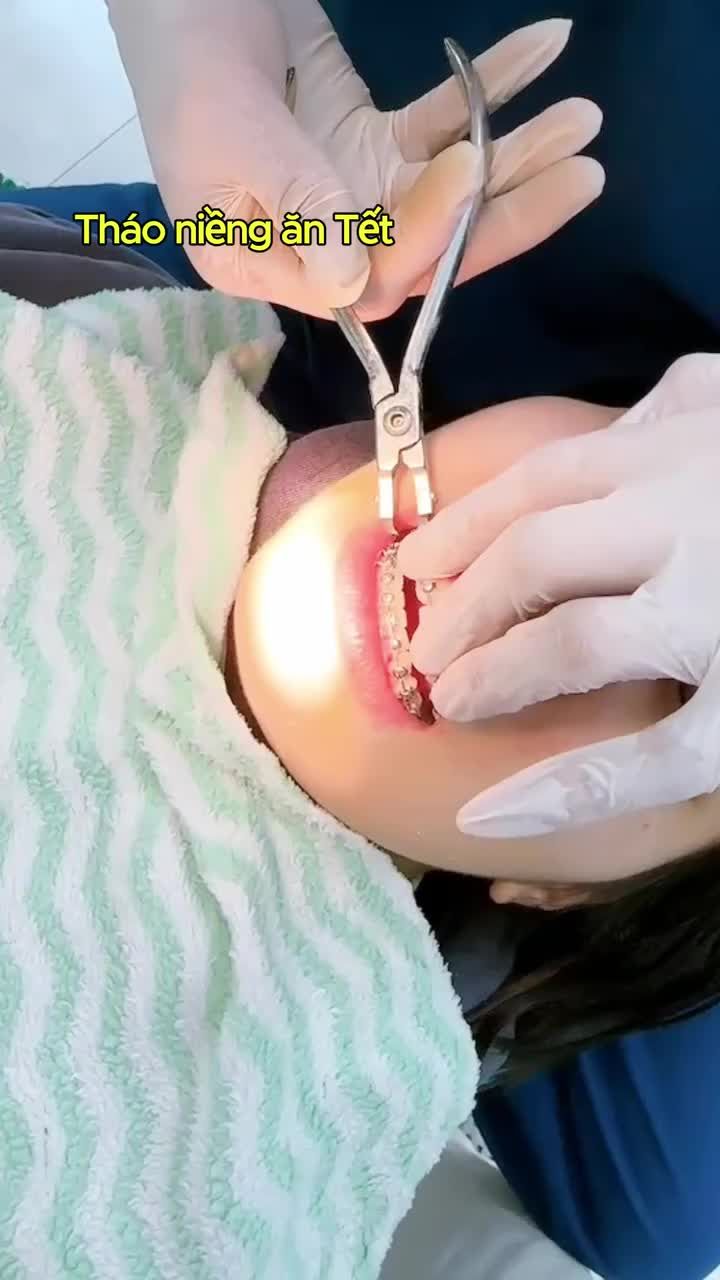 Sắp Tết rồi, tháo niềng thôi