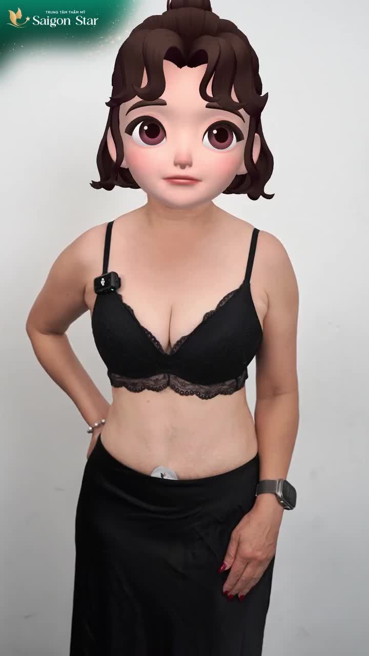 ĐẶT TÚI QUÁ TO DẪN ĐẾN ĐAU LƯNG CHỊ KHÁCH QUYẾT ĐỊNH TỪ MỸ VỀ TÌM BÁC SĨ HOẠT ĐỄ NÂNG CẤP LẠI VÒNG 1 + HÚT M Ỡ ĐỘ EO THON