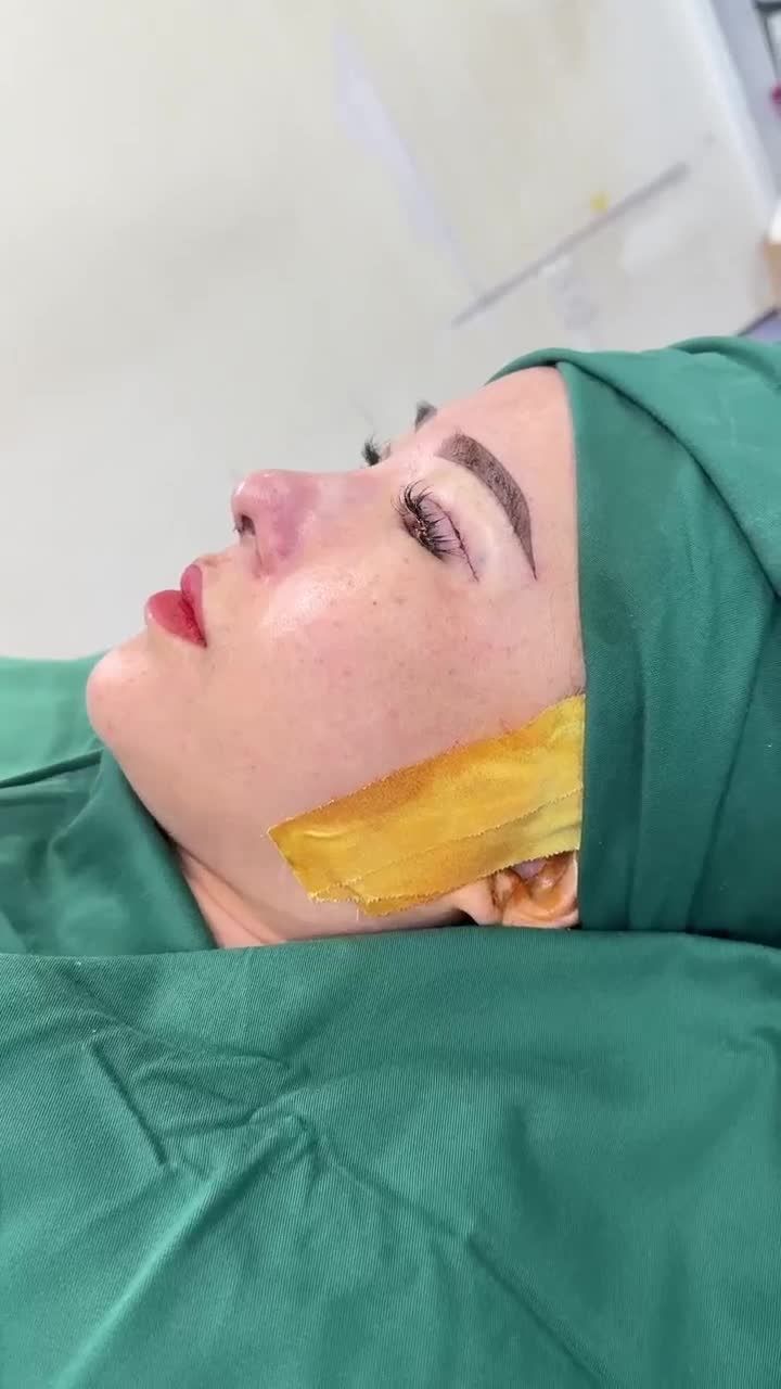 KẾT QUẢ NÂNG MŨI CẤU TRÚC DR. HOẠT + CẮT MÍ MINI DEEP KH. THANH THÚY (MALAYSIA)