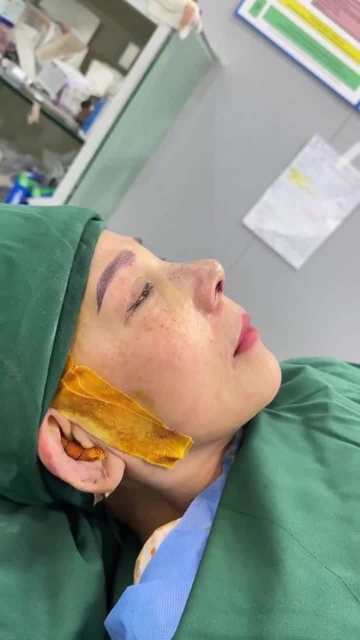 KẾT QUẢ NÂNG MŨI SỬA LẠI KH. LIÊN NGUYỄN (VIỆT KIỀU MỸ)…